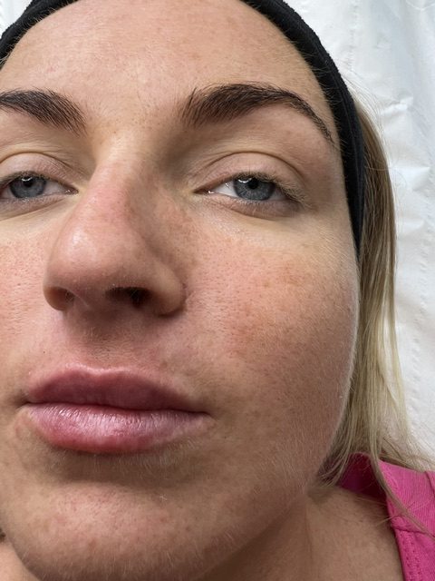 women zoom face image to show lip filler effect