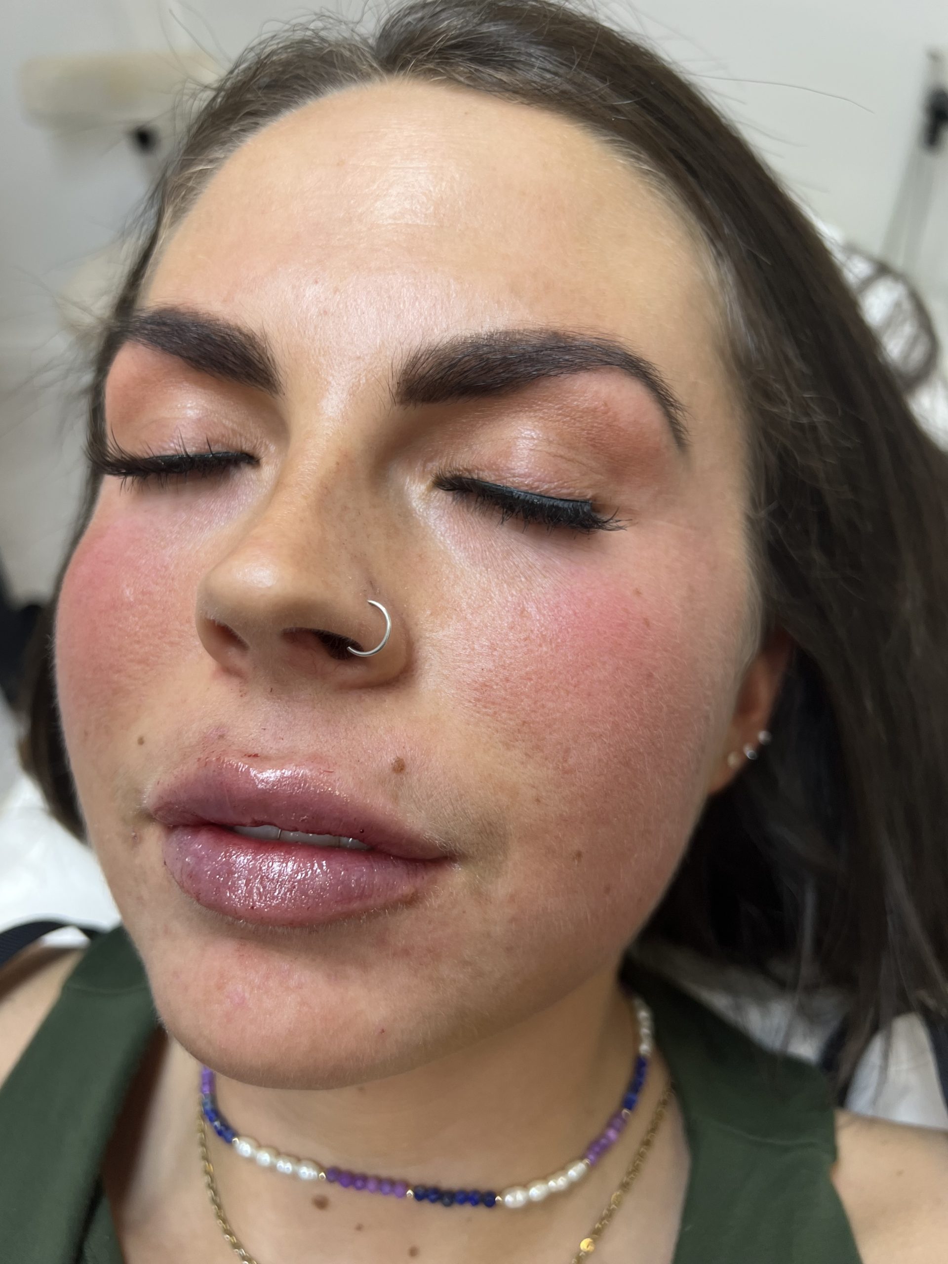 women closed her eyes and image focused on lips they show lip filler effect