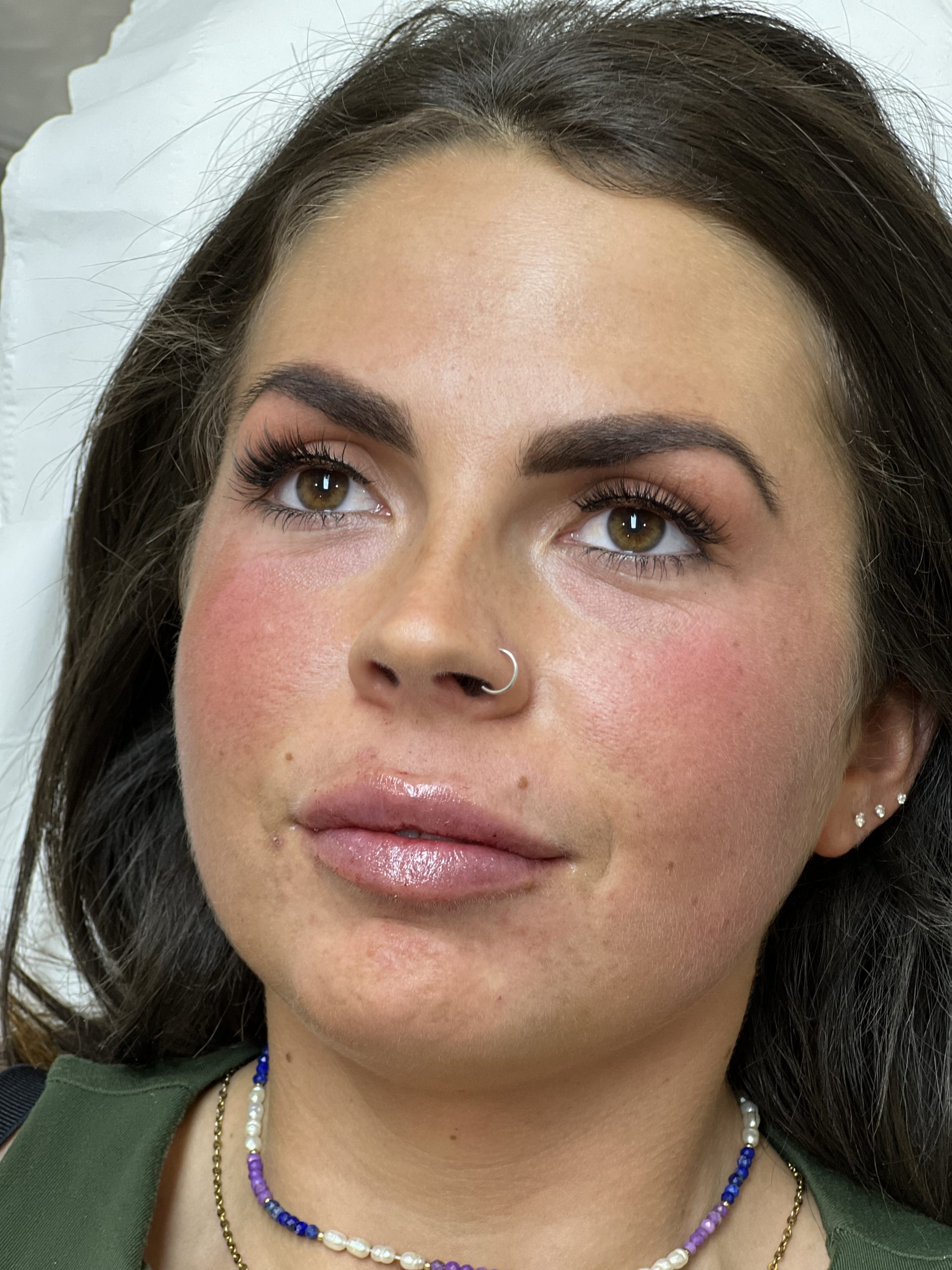 women show after lip filler effect on her face